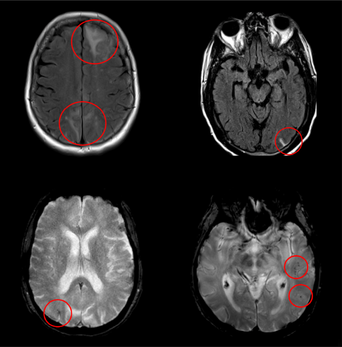 An image showing a selection of MRIs highlighting the presence of ARIA